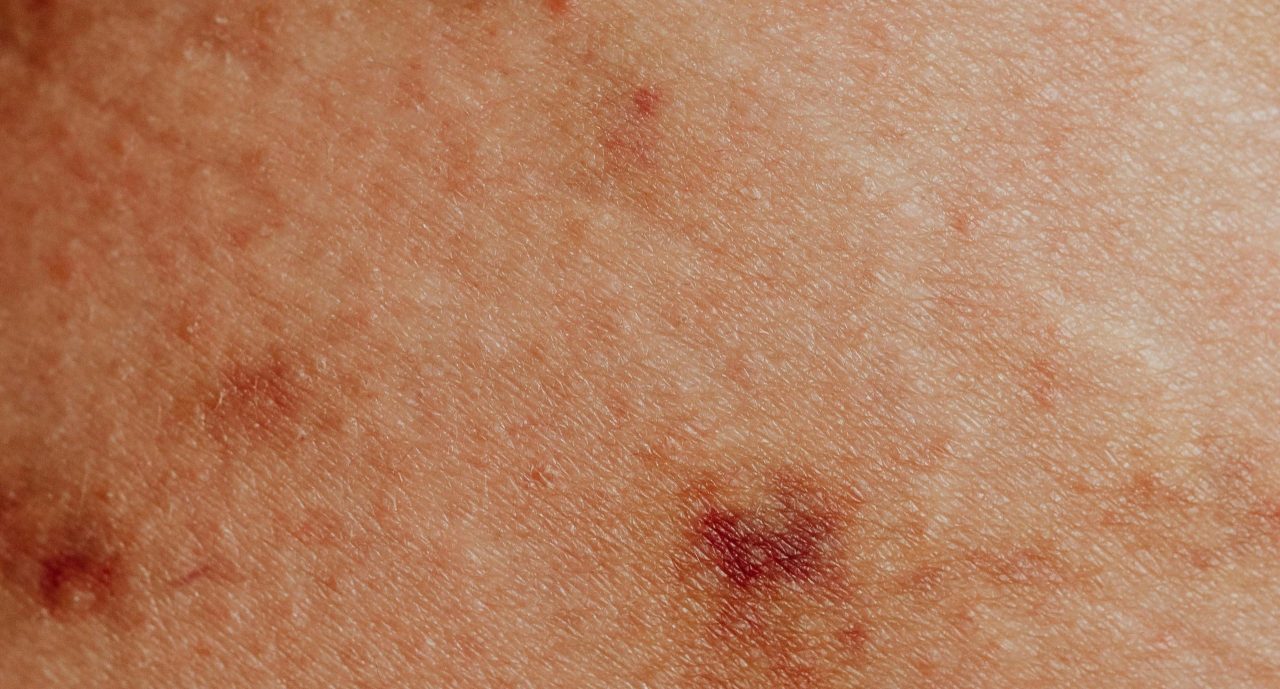 Sindromul Haim-Munk, o boala rara a pielii care necesita o atentie deosebita inca de la primele simptome