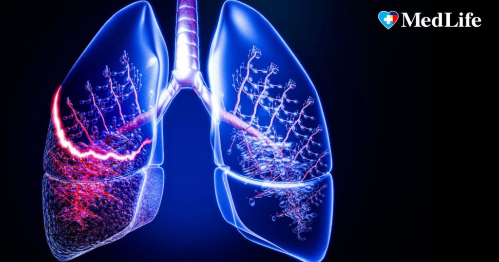 Tusea Persistenta: Semne de Alarmă pentru Bolile Pulmonare Ignorate de Multi