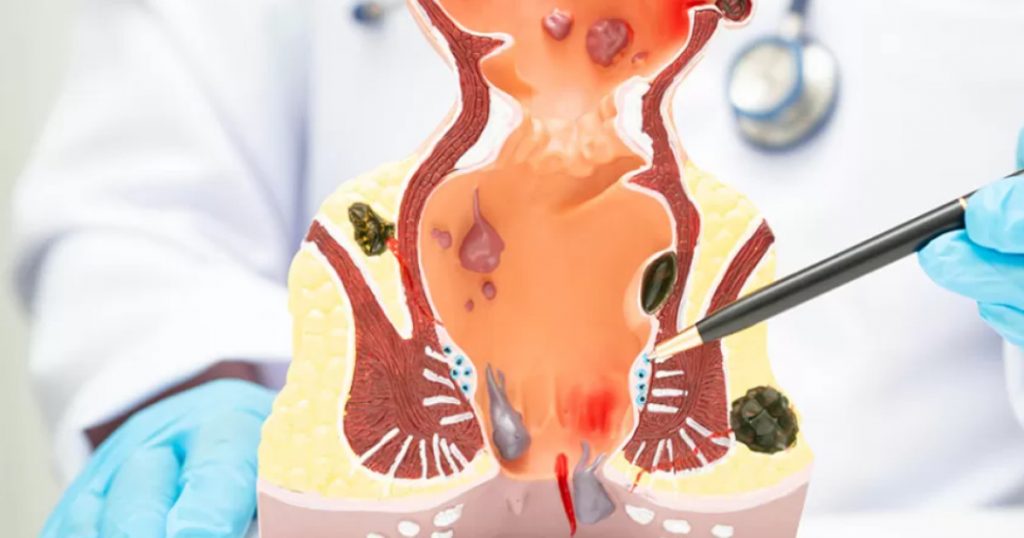 Chirurgia robotică: O nouă speranță în lupta împotriva cancerului rectal metastatic
