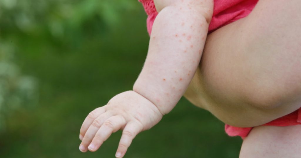 Criza rujeolei în România: Un apel urgent la vaccinare și responsabilitate socială