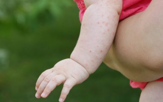 Criza rujeolei în România: Un apel urgent la vaccinare și responsabilitate socială