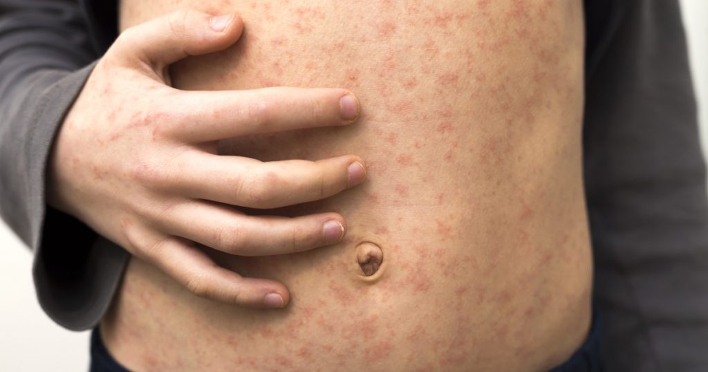Rujeola în Pennsylvania: Un semnal de alarmă asupra vaccinării și sănătății publice